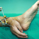 Illustration for article titled Amazing photo of severed hand surgically attached to an ankle